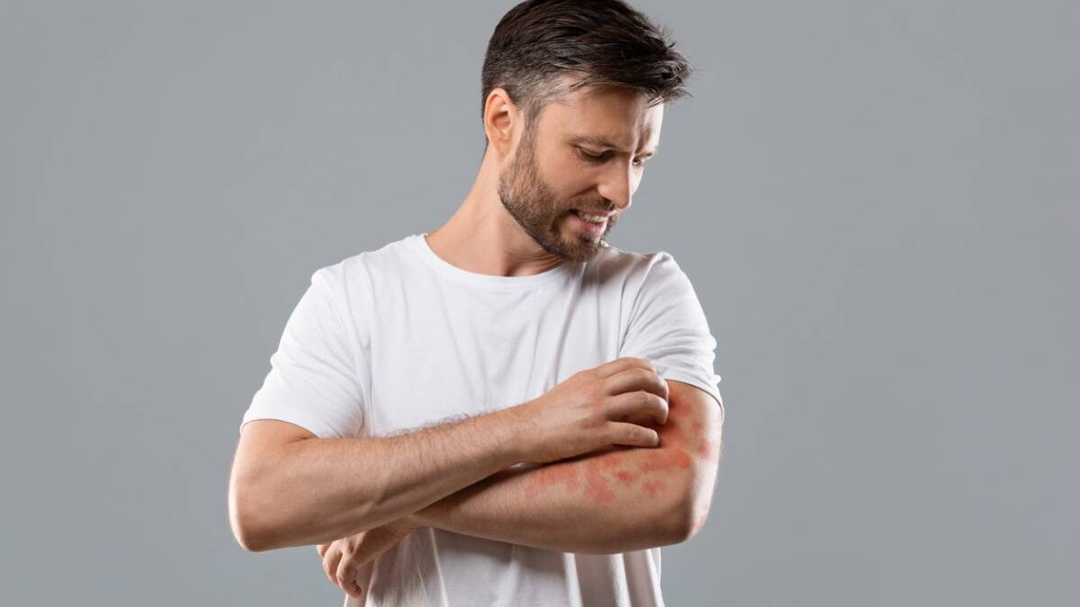 Psoriasis : apaiser les poussées avec des soins naturels