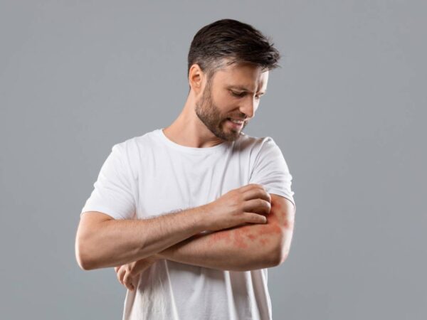 Psoriasis : apaiser les poussées avec des soins naturels