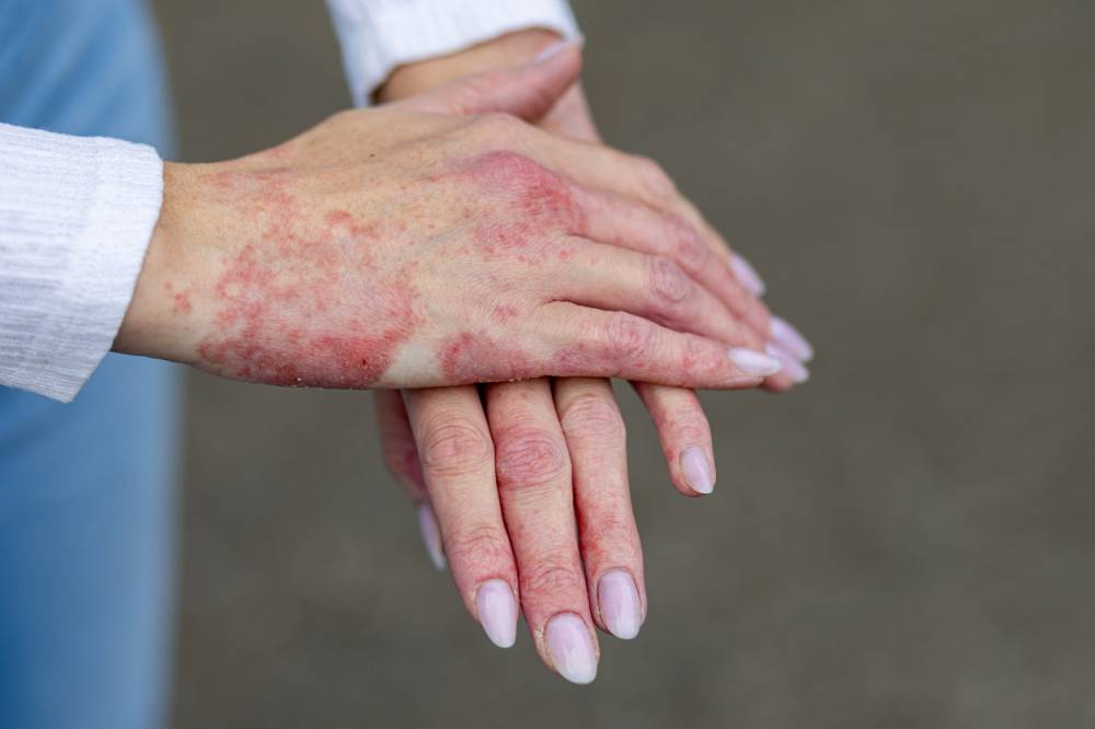 psoriasis pathologie